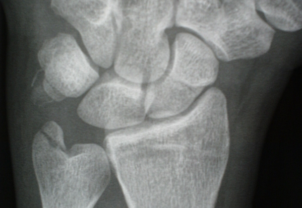 Distal radius fracture